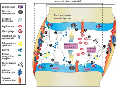 Post-traumatic knee osteoarthritis; the role of inflammation and hemarthrosis on disease progression